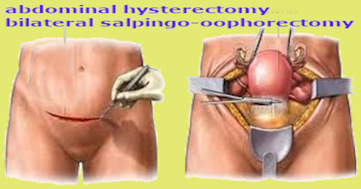 abdominal hysterectomy bilateral salpingo-oophorectomy
