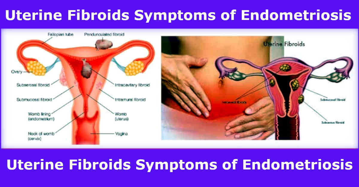 uterine fibroids symptoms of endometriosis