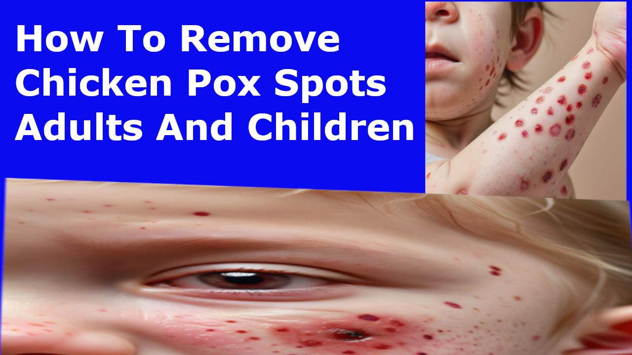 How to remove chicken pox spots adults & children